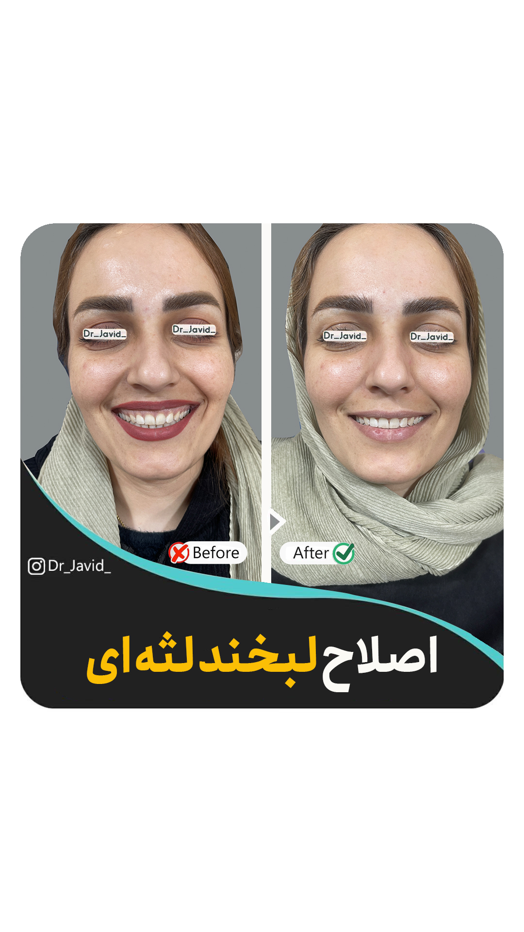 اصلاح لبخند لثه‌ای